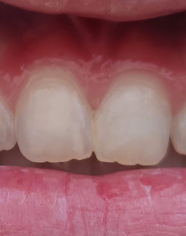 Whitespot (behandelter Karies) — nachher