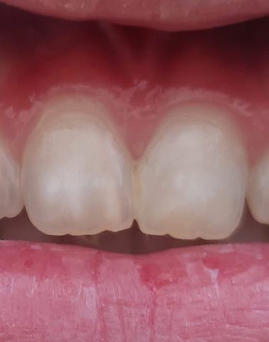 Entstehnder Karies wird als Whitespot bezeichnet