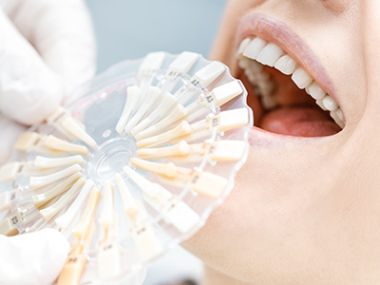 Professionelles Bleaching der Zähne bei Zahnarztpraxis WunschZahn in Wiesbaden